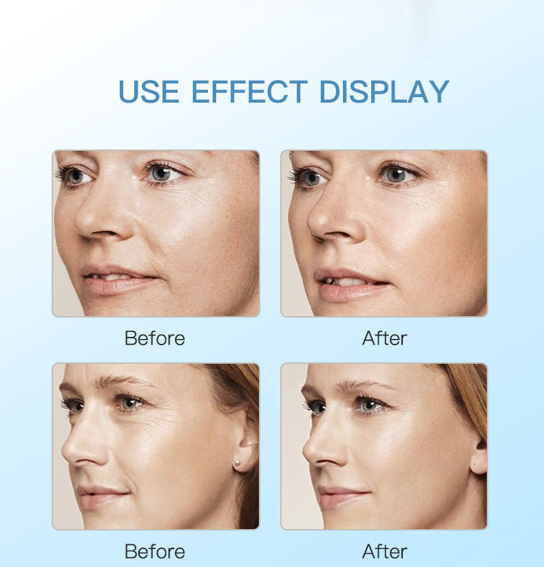 Meso Secret® Skinbooster Hyaluronic Acid 3.5ml * 2 Vials