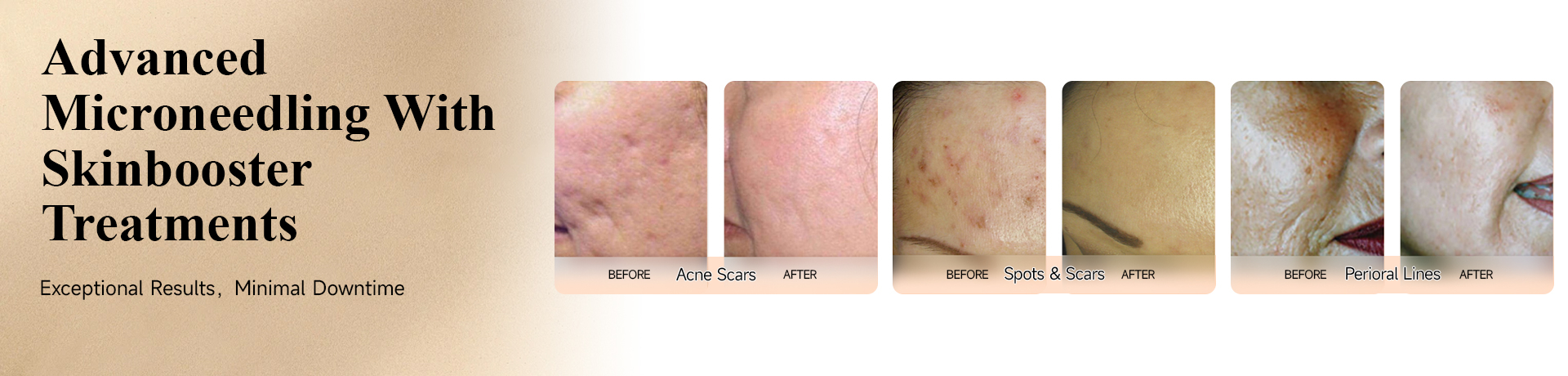 Microneedles, Skinboosters, Microneedle 3/4/5/9pins, Dermal Roller, Mesotherapy Injector, Dr.pen, Dr.pen Cartridges, Hydra Pen, All Products, Promotion - Hebei Ulike Technology Limited